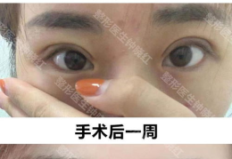 做双眼皮整形医院哪家好,品质与口碑并重的美丽之选