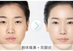 歪鼻整形,歪鼻整形的美丽蜕变之旅