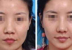 鼻尖整形对比图,美丽蜕变，见证专业技艺